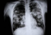 Devastating New Spike of Black Lung Disease Plagues Younger Coal Miners